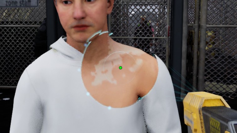 紫外线检测皮疹